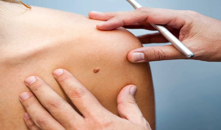 În Republica Moldova crește numărul cazurilor de cancer de piele