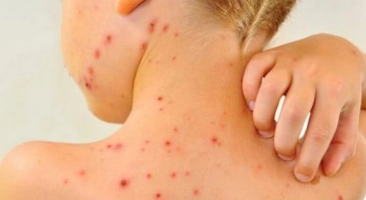 Noi cazuri de rujeolă în capitală. Părinții sunt îndemnați să-și vaccineze copiii